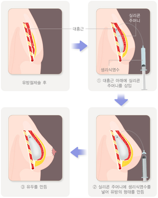 한사랑병원 유방암 유방재건