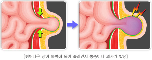 한사랑병원 탈장