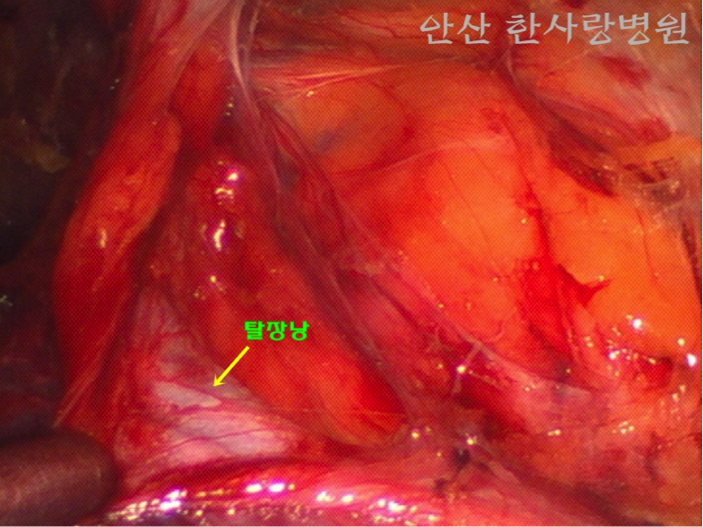 단일통로복강경탈장수술