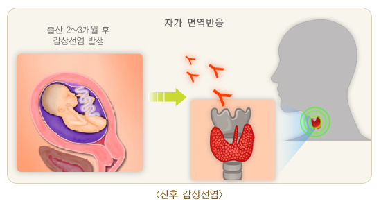 산후갑상선염