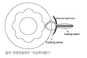 안산한사랑병원 치루