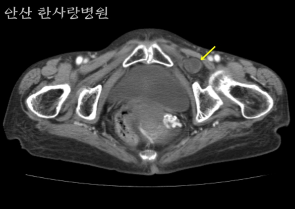 탈장 복부 CT