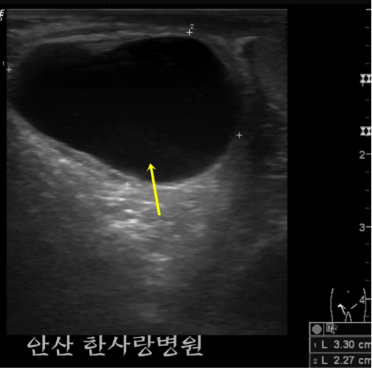 음낭수종 초음파 사진