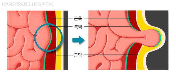 한사랑병원 탈장