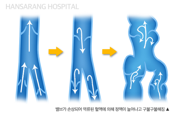 한사랑병원 하지정맥류