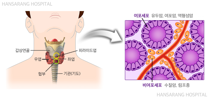 갑상선암