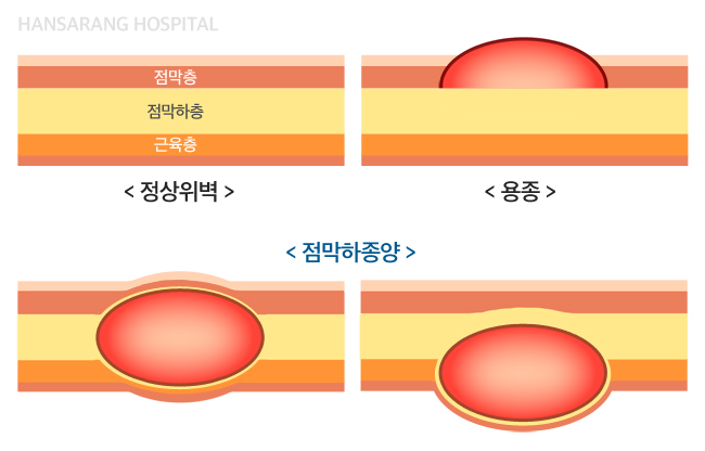 위점막하종양