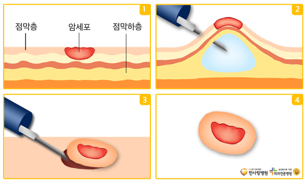 내시경점막하박리술