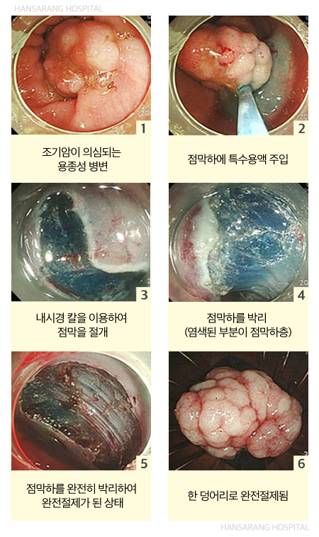 안산한사랑병원 내시경