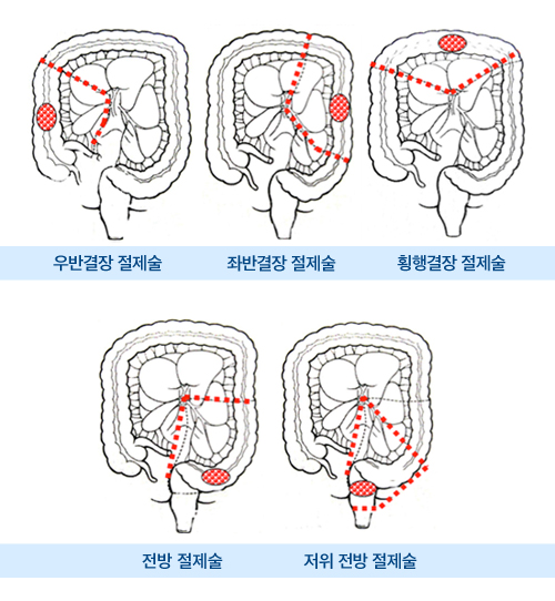 복강경대장암수술