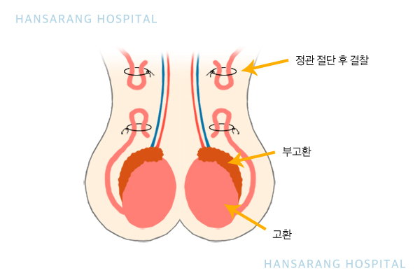 한사랑병원 정관수술