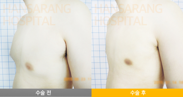 한사랑병원 여유증 여성형유방