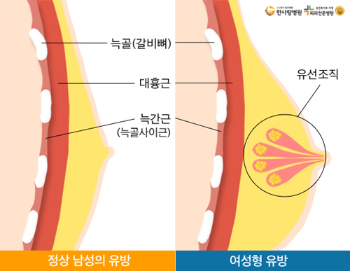한사랑병원 여유증 여성형유방